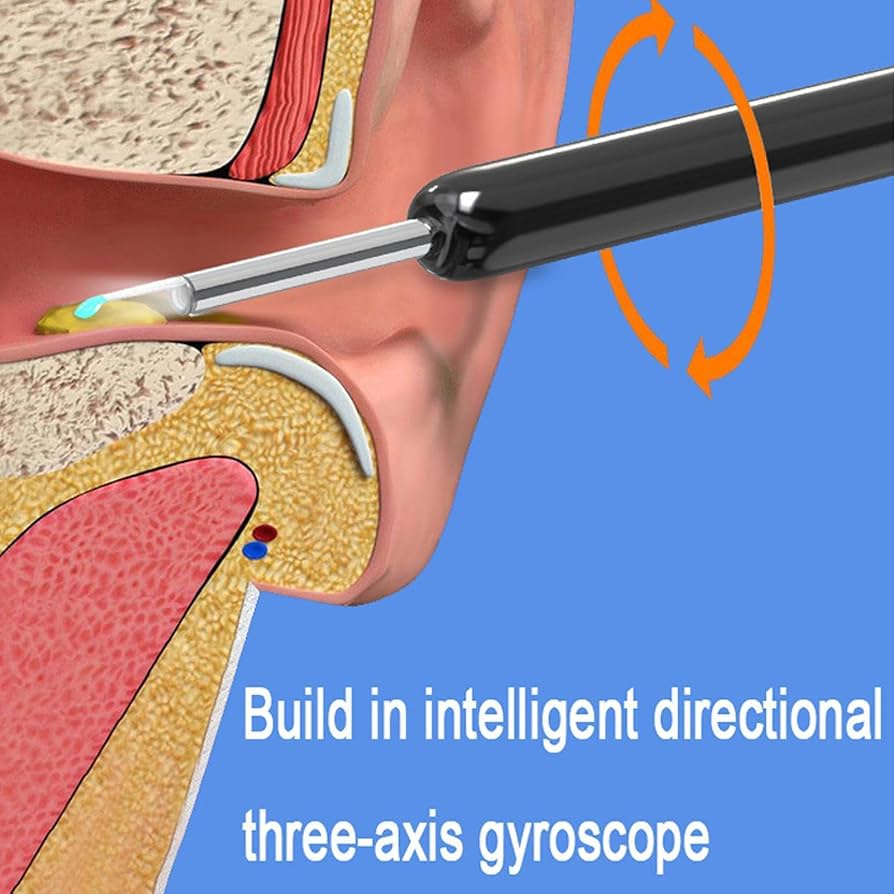 Ear Wax Elimination Kit | Wifi-1080p HD Load Otoscope